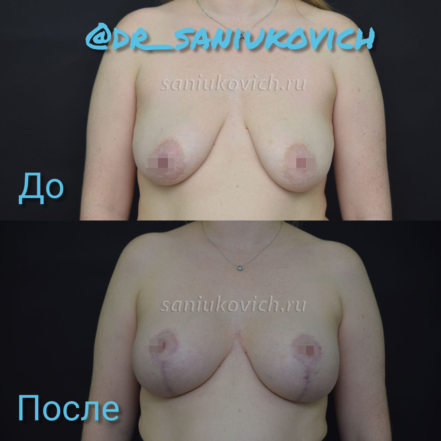 уменьшение груди с 4 размера по 2 фото 62
