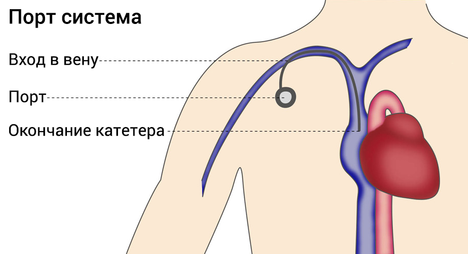 Установка порта. Центральный венозный порт. Установка порта для химиотерапии схема.