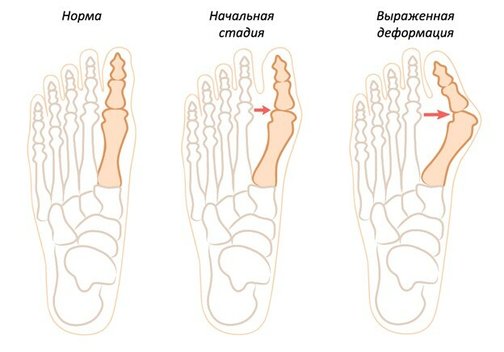 Причины появления «шишки» на ноге
