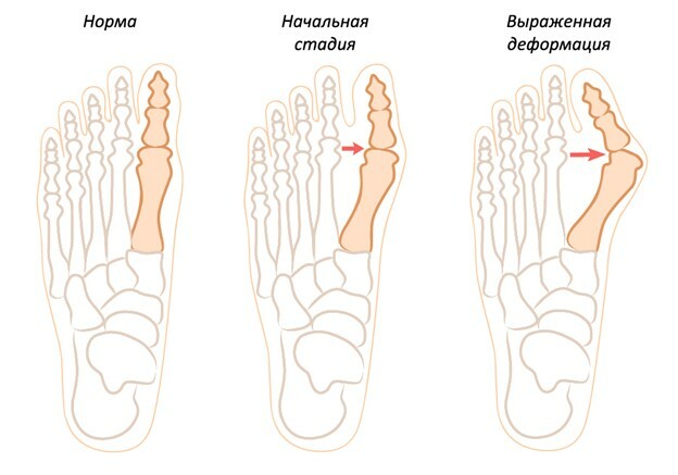 Причины судорог пальцев ног и их лечение