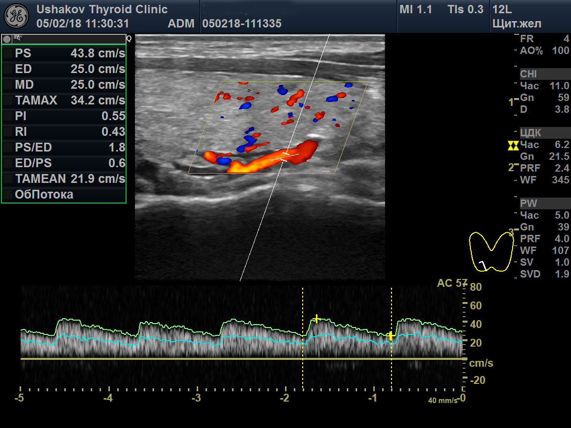 Кровоток в щитовидной железе. Кровоток щитовидной железы УЗИ. Скорость кровотока щитовидная железа УЗИ. Допплеровское исследование щитовидной железы протокол. Кровоток в щитовидной железе норма.