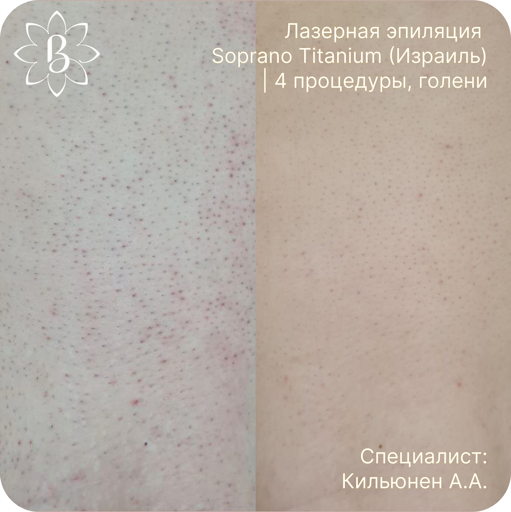 Лазерная эпиляция 