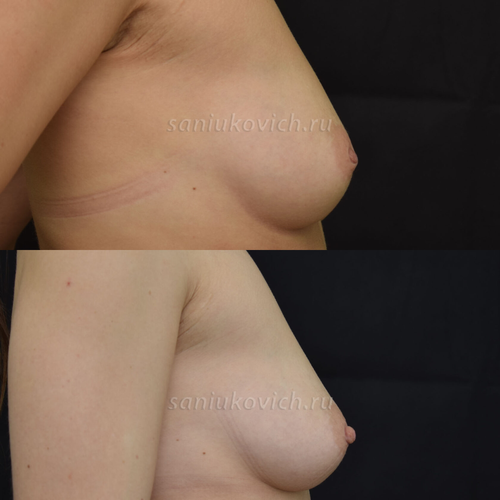 маммопластика грудь одна не опустилась фото 24
