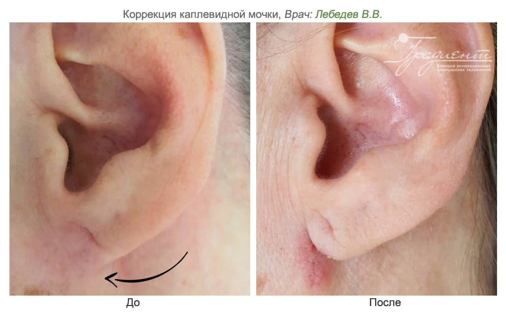 Отморозила ухо - Форум Зеленограда