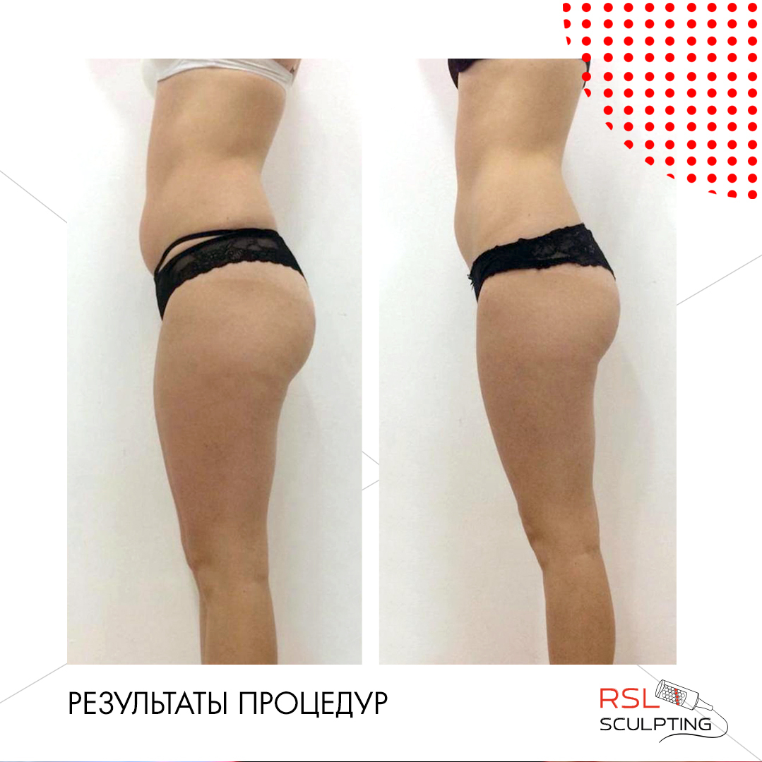 Эндосфера терапия для тела и лица в Москве - цена процедуры в клинике XELLA