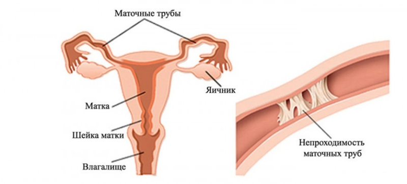 Можно вылечить непроходимость труб. Непроходимость маточных труб узи. Методы проходимости маточных труб. Гистеросальпингография непроходимость. Непроходимость фаллопиевых труб.