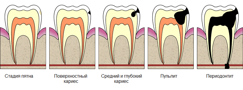 Виды кариеса зубов фото