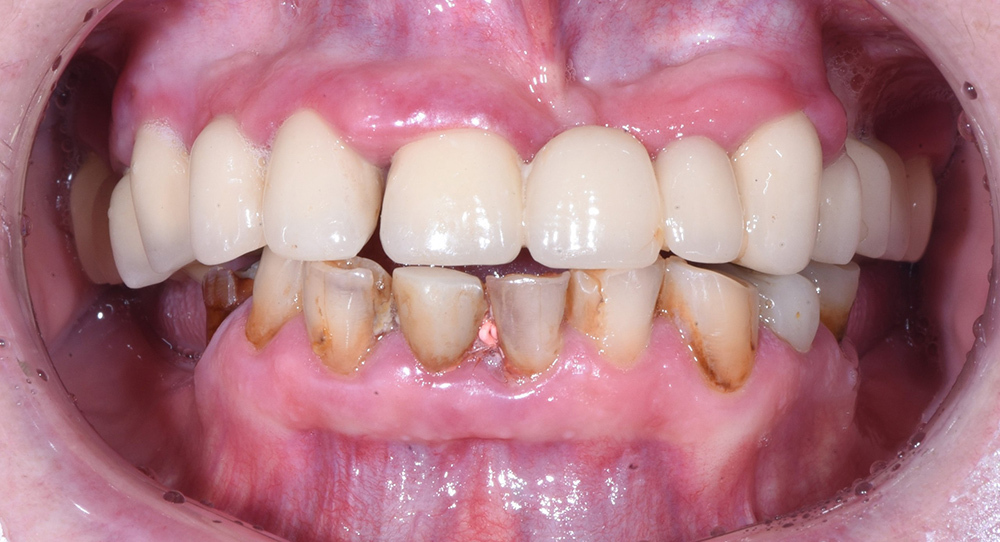 Восстановление зубного ряда обеих челюстей с имплантацией All-on-6 Osstem