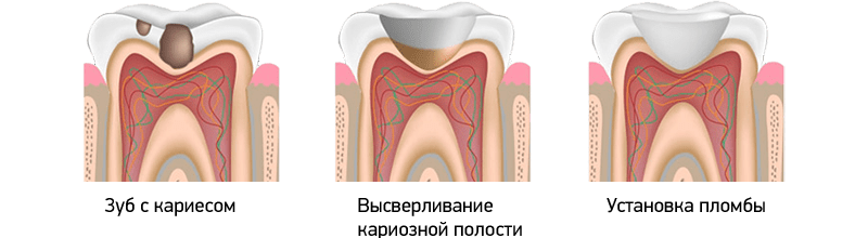 Пломбируют Зуб Фото