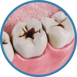 Установка имплантов в Дербенте. Имплантация при отсутствии одного зуба.