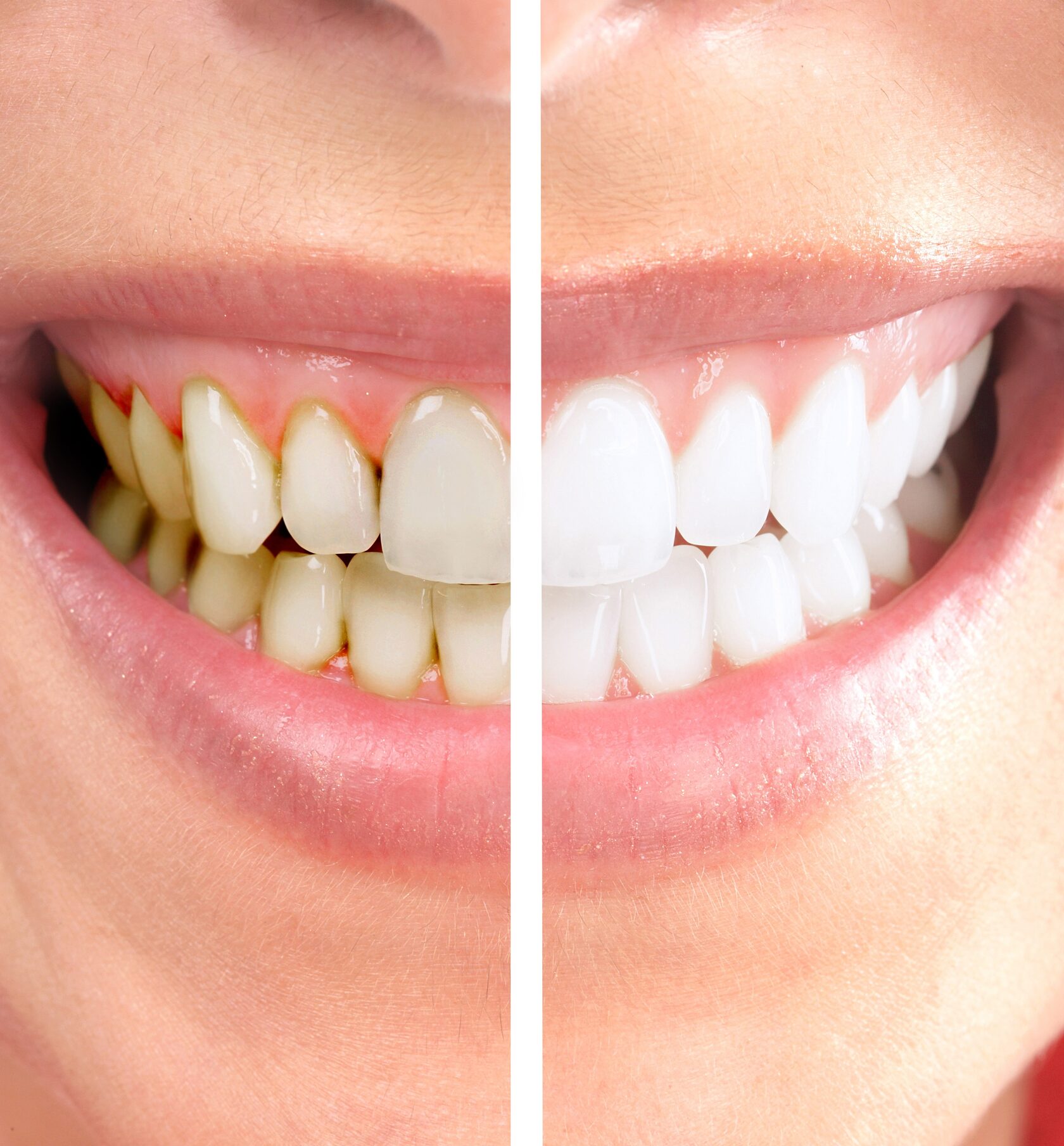 Профессиональная чистка зубов у стоматолога. Профессиональная гигиена зубов. Зубы после профессиональной чистки. Профессиональная чистка зубов до и после.