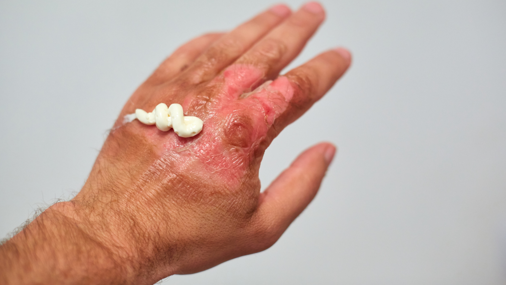 Что такое ожог первой степени