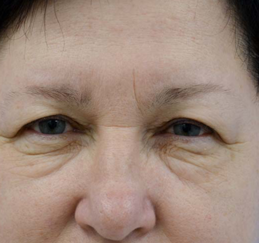 Scars and seals after blepharoplasty