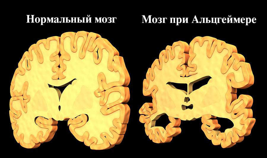 Тесты против альцгеймера с картинками