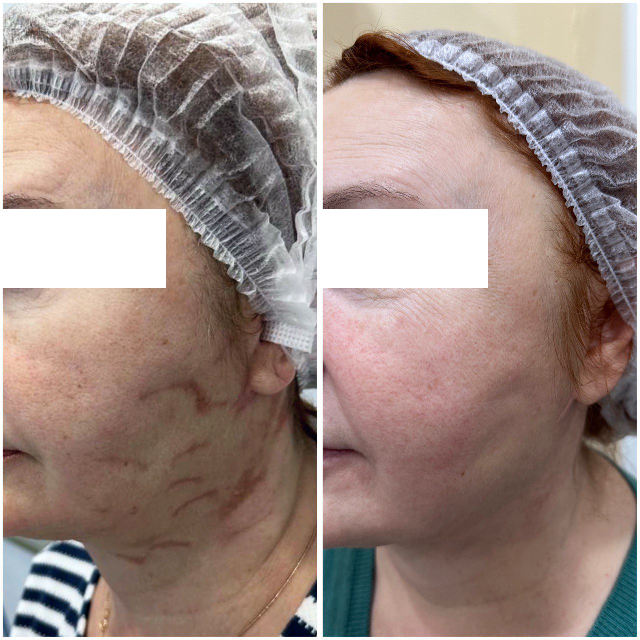 Результат удаления шрама у пациента — косметолог Пузикова Анна Анатольевна, Санкт-Петербург