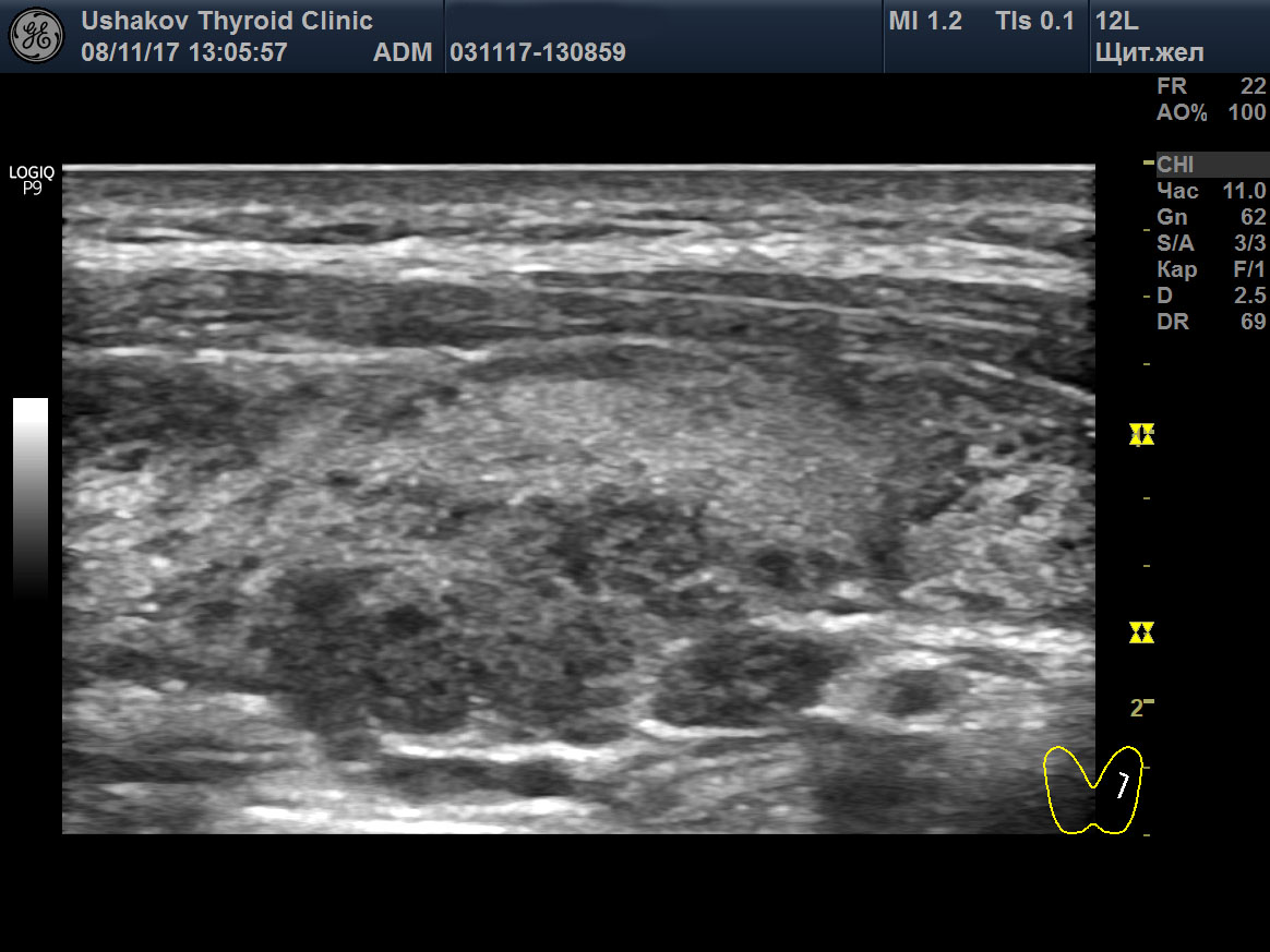 Узловое образование щитовидных желез. Многоузловой зоб щитовидной железы УЗИ. Узловая форма щитовидной железы на УЗИ. Множественные узловые образования в щитовидной железе. Ушаков УЗИ щитовидной железы.