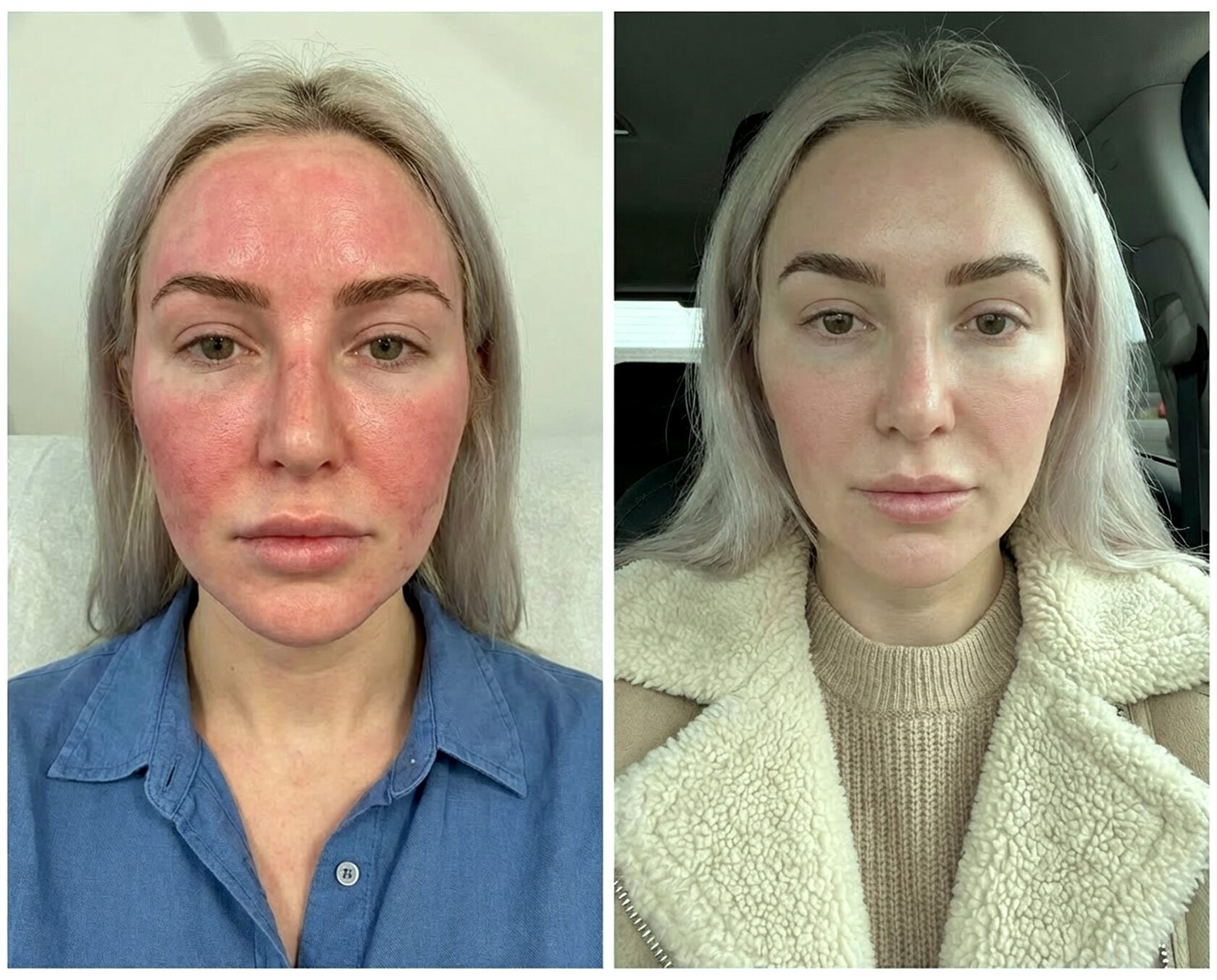 результаты рф лифтинг морфеус лицо до и после 