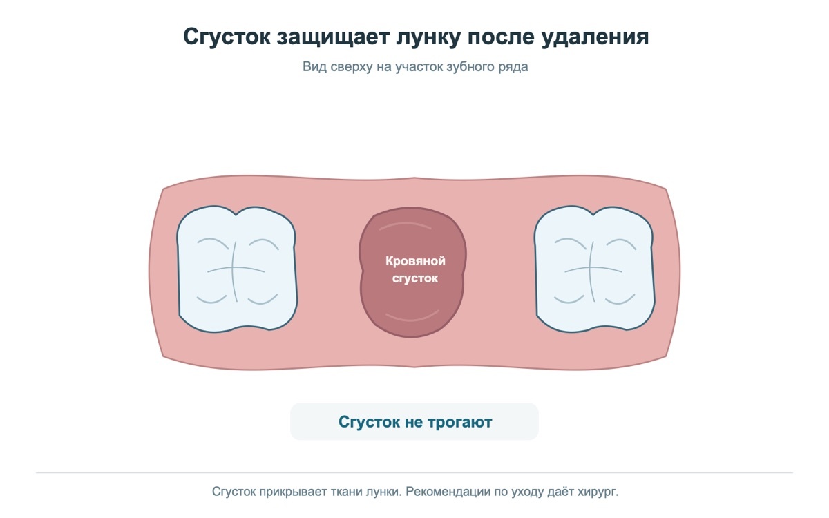 Кровяной сгусток защищает лунку после удаления зуба
