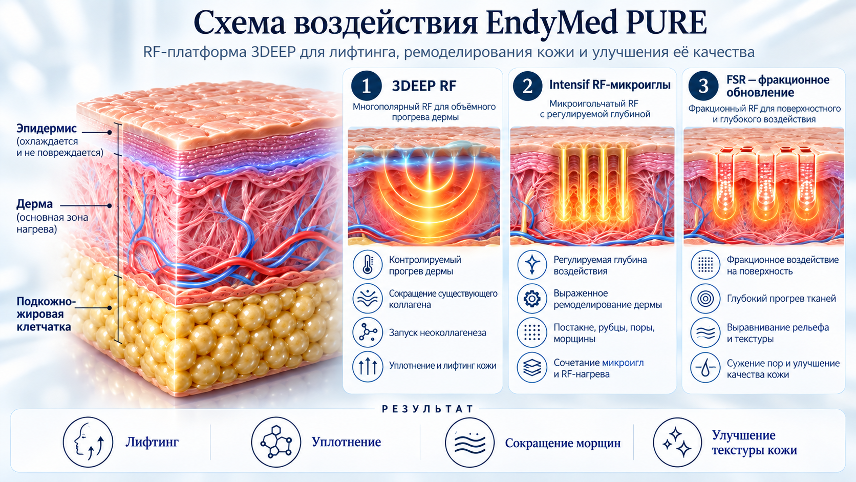 Схема технологии EndyMed 3DEEP RF