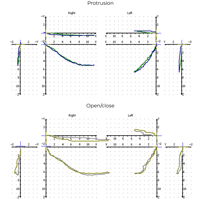 Снятие оттиска трансфером для открытой ложки