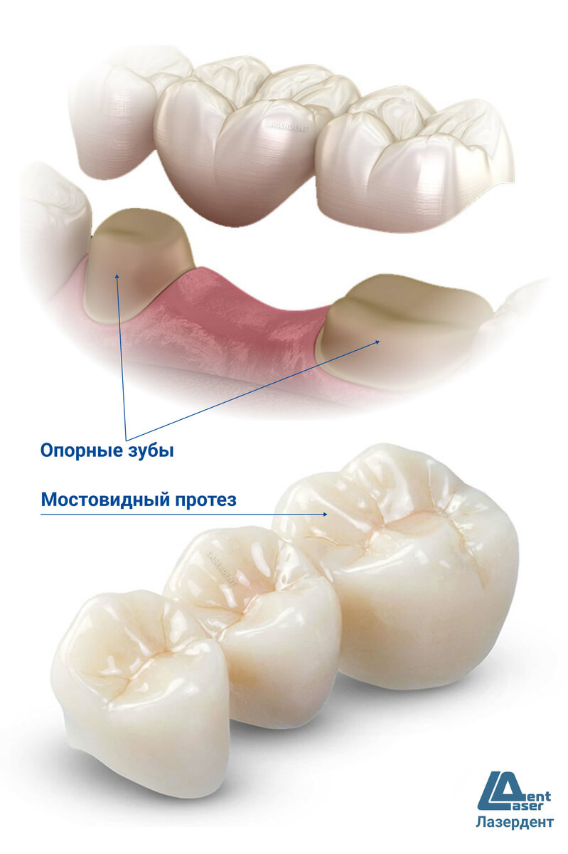 Установка зубного моста, цены, виды, особенности, снятие и изготовление нового моста