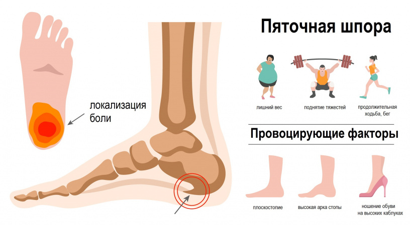 Плантарный фасциит картинка