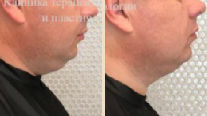 Криолиполиз Zeltiq на подбородок в Новосибирске | Цены на подтяжку ...