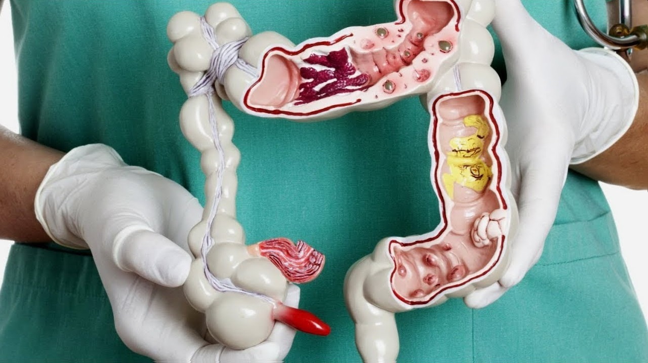 Можно ли вылечить геморрой дома
