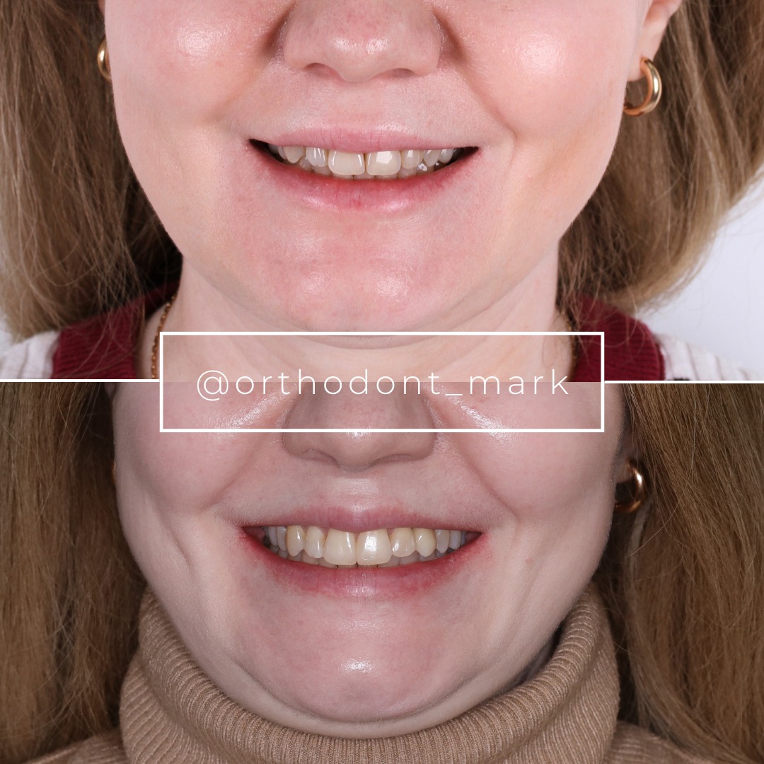 Before photo showing shifted smile midline and crowding from early canine loss — photo 1 of 3