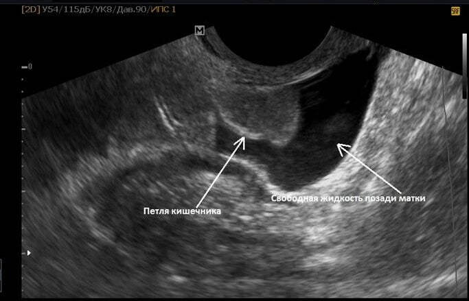 Жидкость в малом тазу у женщин за маткой