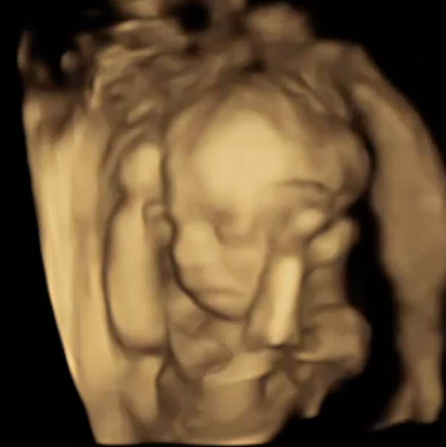 ПРЕНАТАЛЬНАЯ ДИАГНОСТИКА ВЕСЬ ПЕРВЫЙ ТРИМЕСТР