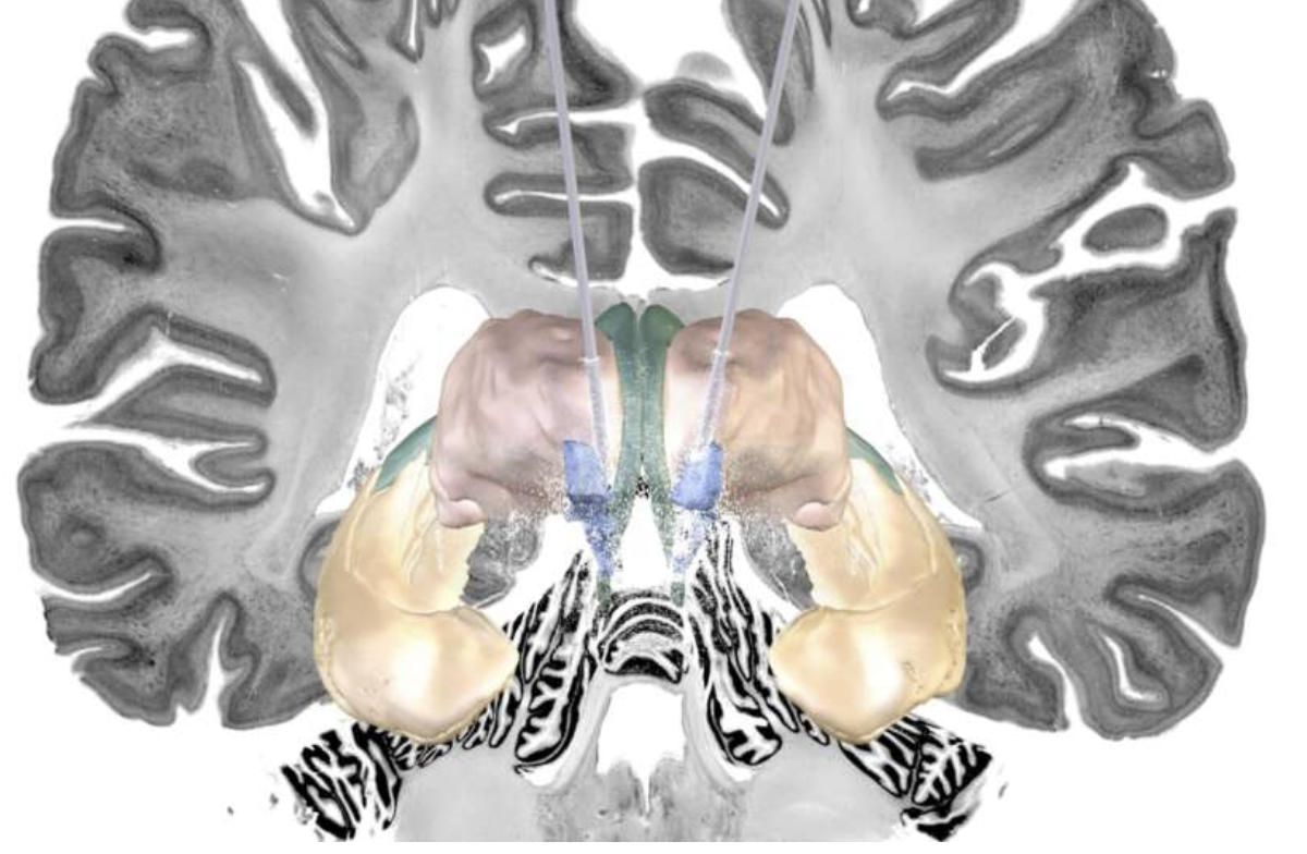 Глубокая стимуляция мозга может помочь в лечении болезни Альцгеймера