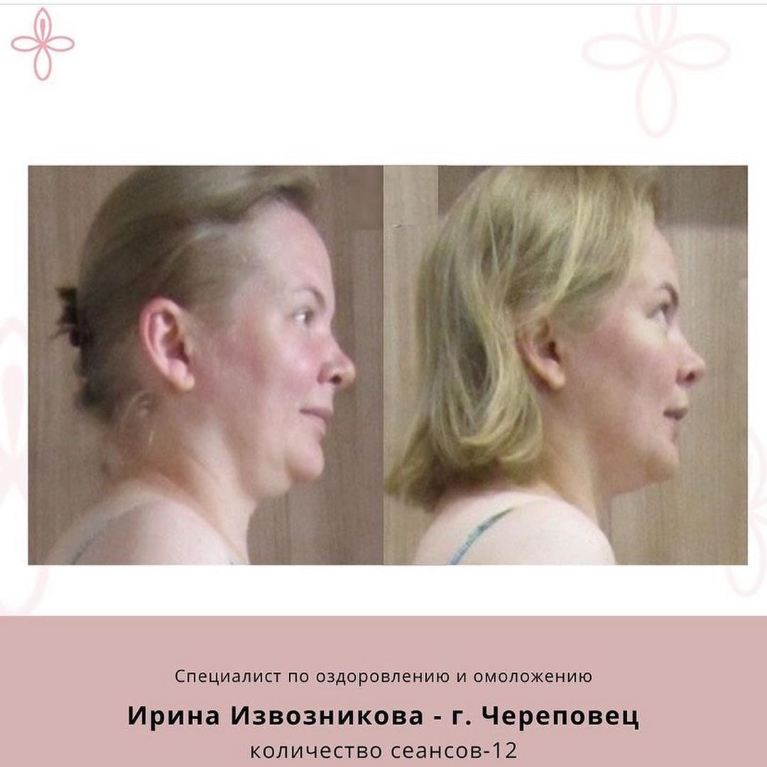 Молодость. Ревитоника до и после фото. Академия омоложения. Академия омоложения. Студия омоложения.
