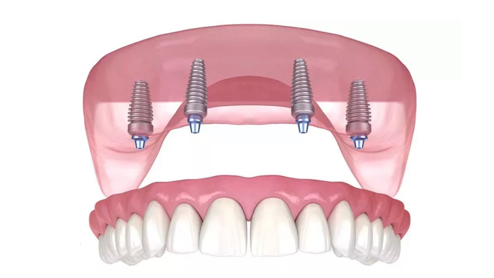 бюгельный протез на 2 зуба. зубные протезы под ключ. протез acry 4 передних зуба. полносъемные протезы ортопедическая стоматология. зубной протез сочи.