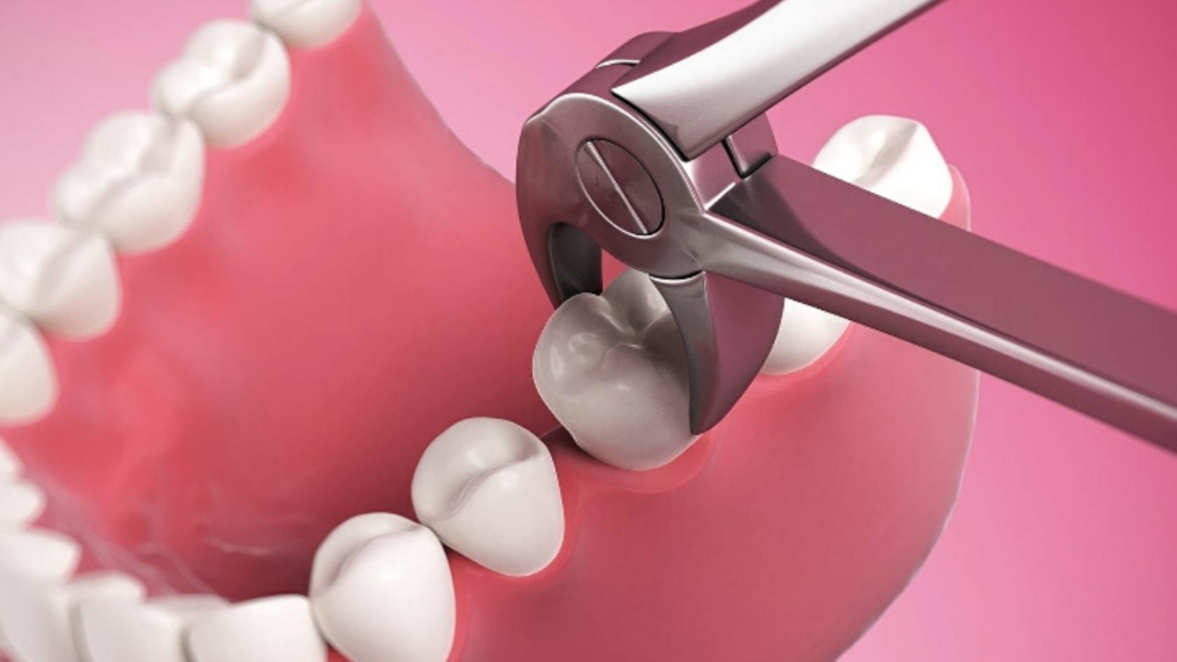 Tooth extraction. Хирургическая стоматология.