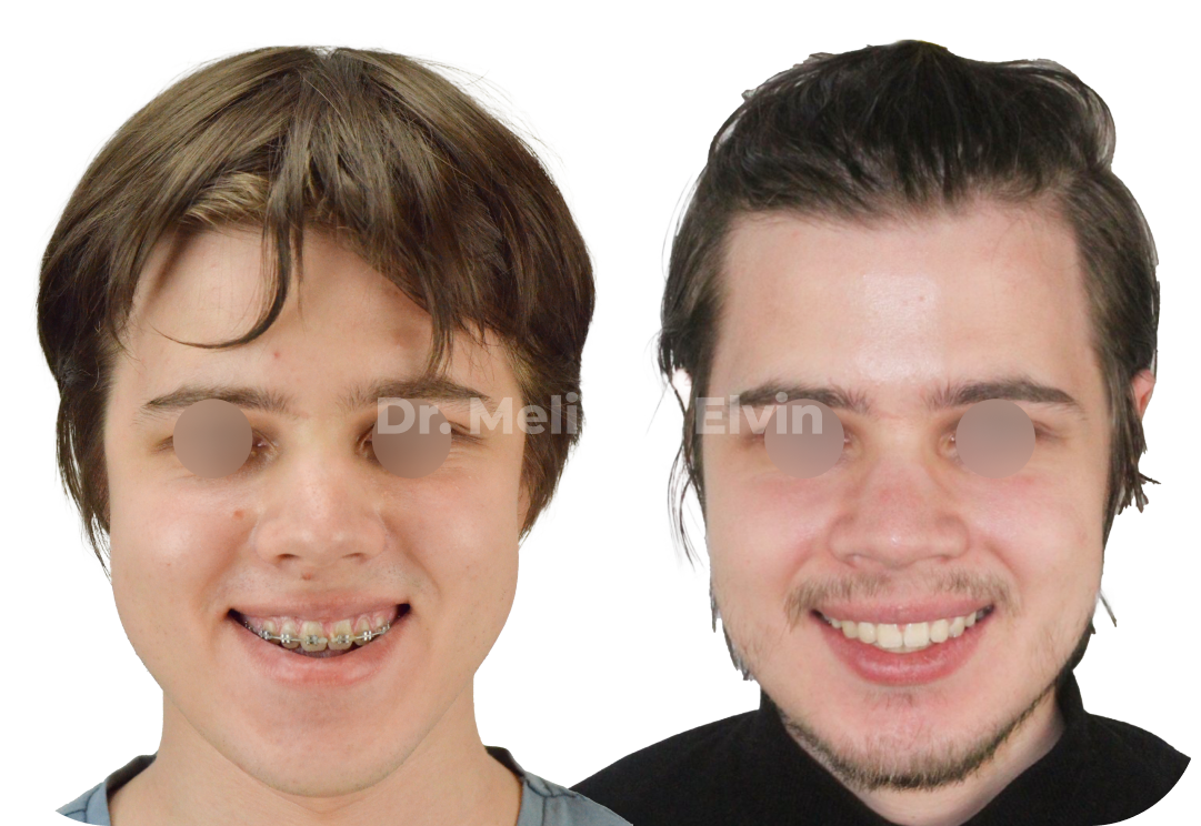 Фотографии до и после ортогнатической операции.