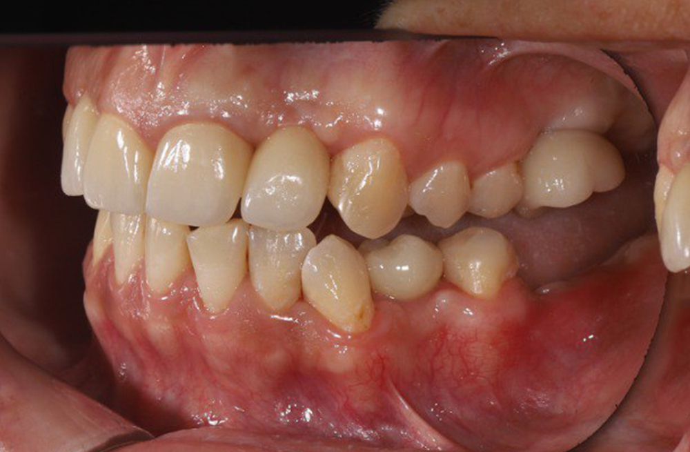 Протезирование зуба с заменой коронки на импланте