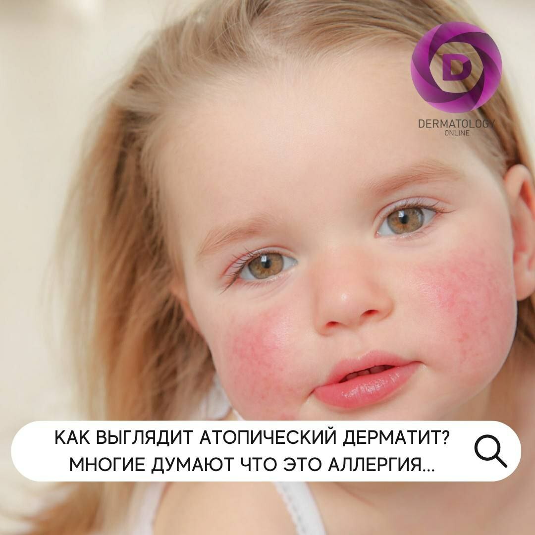 Атопический дерматит что это, лечение, причины, консультация