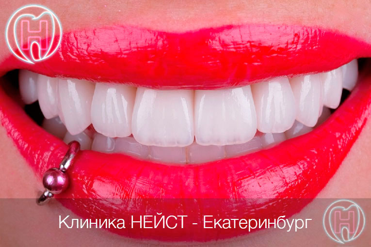 Керамические виниры emaxв Екатеринбурге цвет Блич 3 (Bleach 3)