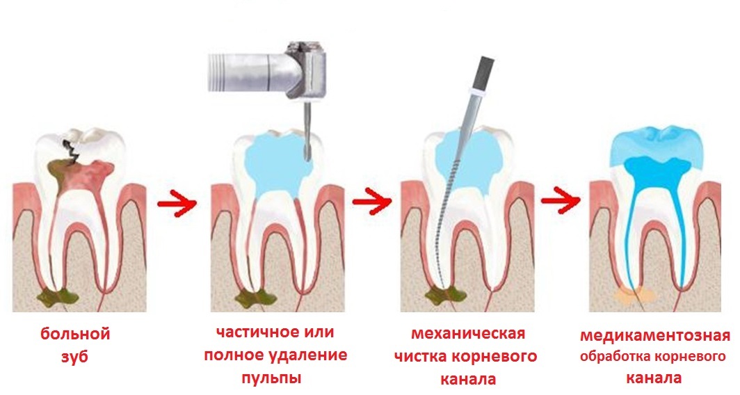 Удаление кисты без удаления зуба — хирургические методы