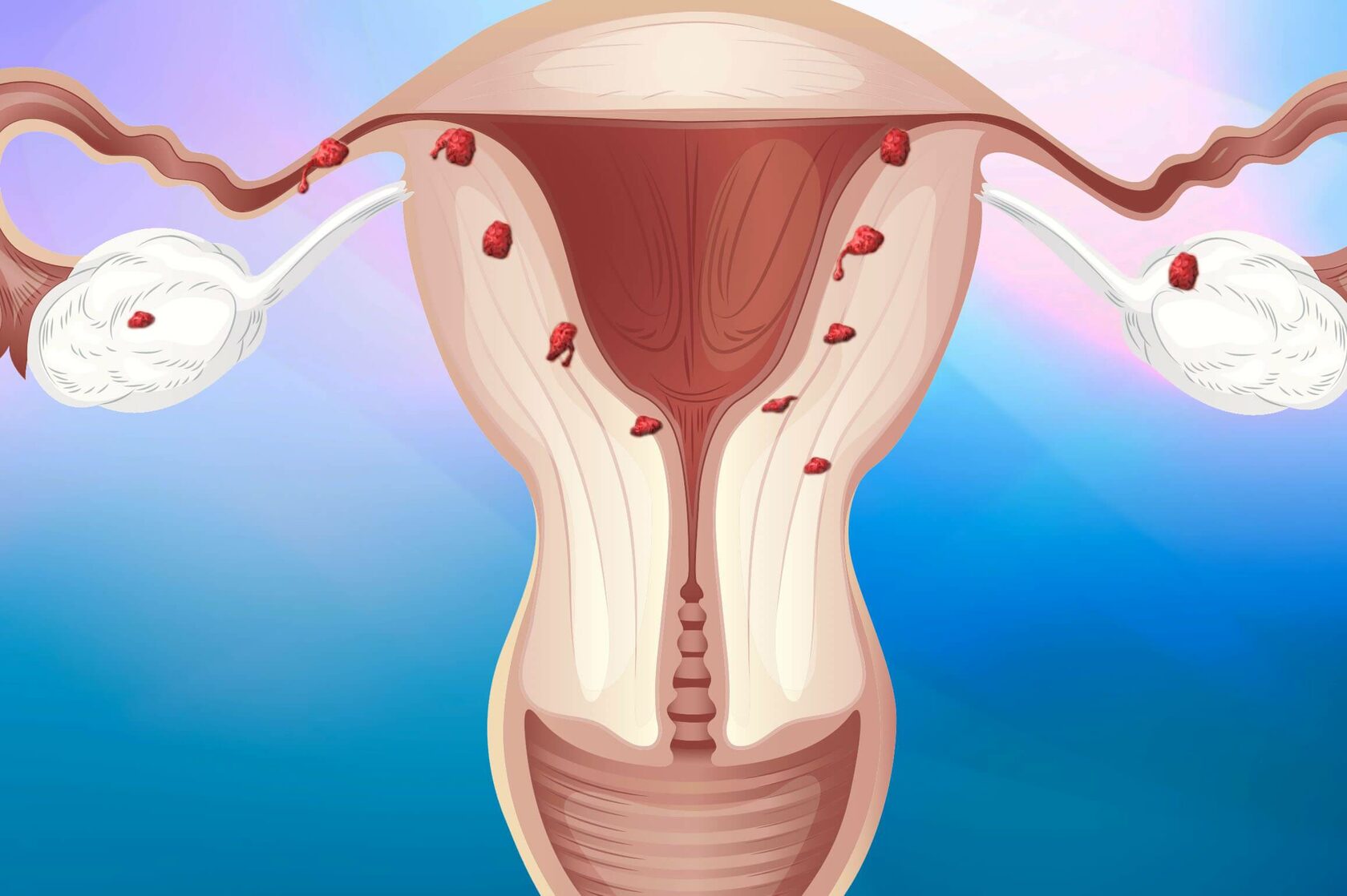 Надвлагалищная ампутация матки (субтотальная гистерэктомия)