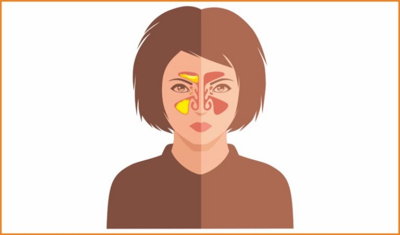 Острый и хронический синусит у взрослых: частые симптомы и лечение