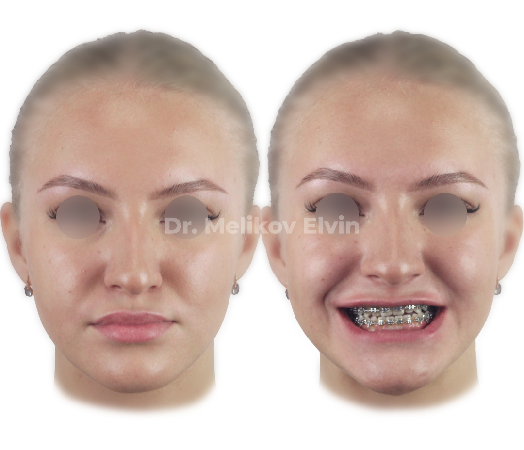 Мезиальный прикус