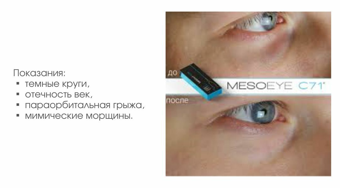 Мезоай с 71. МЕЗОАЙ. MESOEYE с71 (МЕЗОАЙ). МЕЗОАЙ С 71 фото до и после. МЕЗОАЙ под глаза до и после фото.