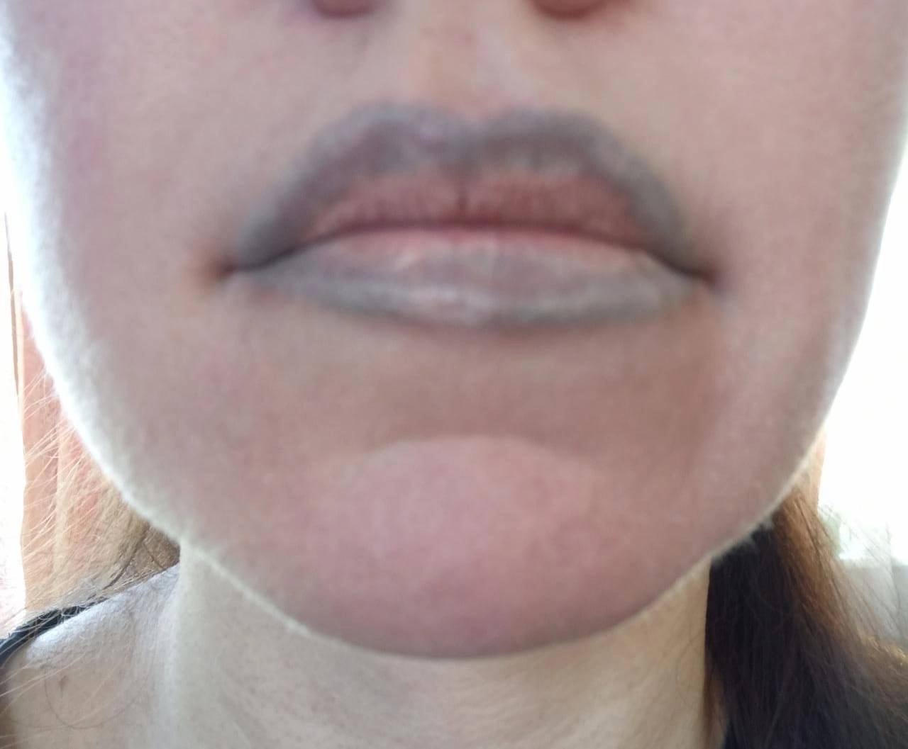 Удаление перманентного макияжа губ лазером. Ошибки