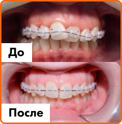 Установка имплантов в Дербенте. Имплантация при отсутствии одного зуба.