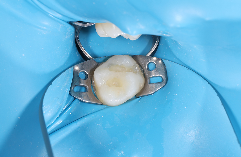 Лечение кариеса жевательного зуба ребенку 11 лет