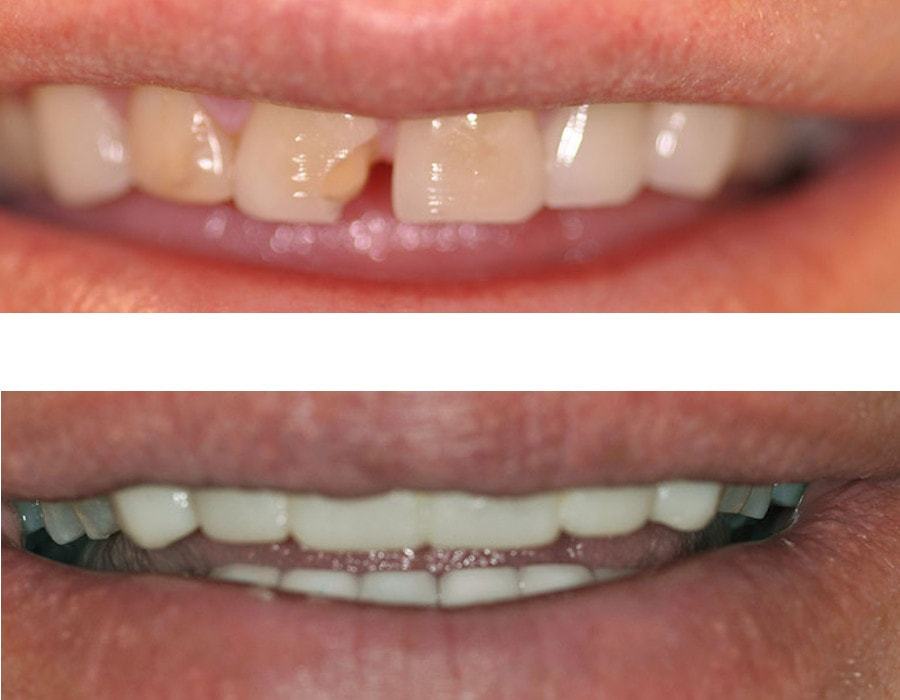 Реставрация зубов: фото до и после