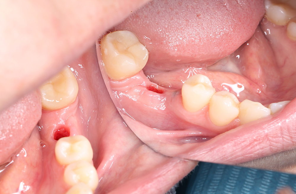 Восстановление функции зуба при частичной вторичной адентии с использованием формирователя десны и циркониевой коронки