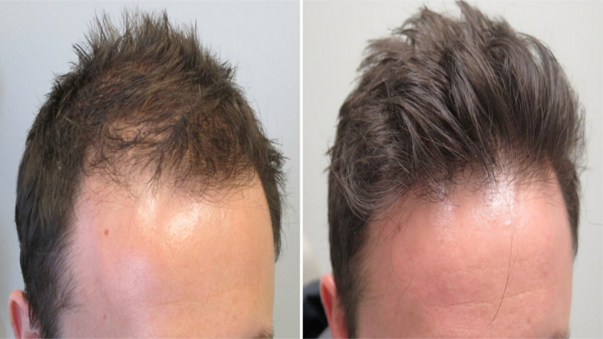 Из-за чего могут выпадать волосы на бровях у мужчин